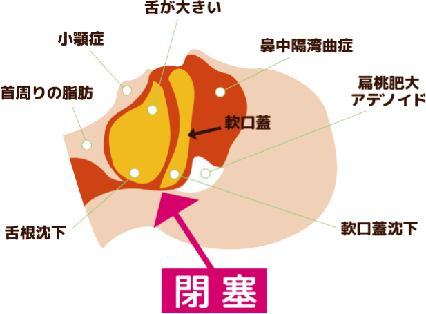 睡眠時無呼吸症候群の原因